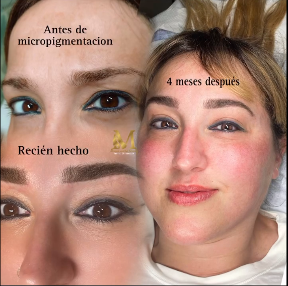 Micropigmentación - Resultado 6